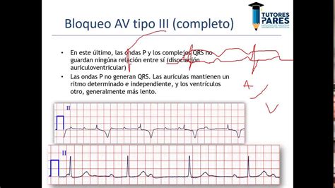 Guia En Electrocardiograma Arritmia Cardiaca Electrocardiografia ...