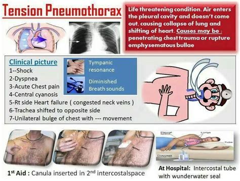 Pneumo | Emt study, Nurse, Critical care nursing