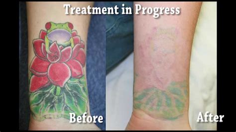 Bright Color- Tattoo Removal - YouTube