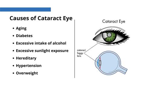 EVERYTHING YOU NEED TO KNOW ABOUT CATARACT! - OPHTHALMOLOGY