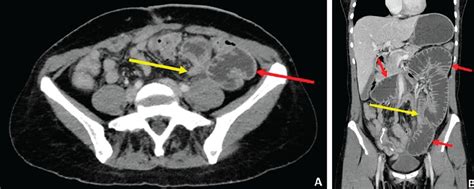 Why Ct Scan Abdomen Pelvis