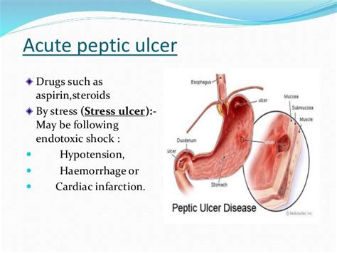 Acute peptic ulcer | Ulcers, Peptic ulcer, Stress