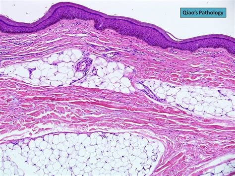 Qiao's Pathology: Nevus Lipomatosus Cutaneous Superficiali… | Flickr