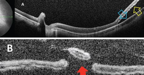 Tractional Retinal Detachment Oct