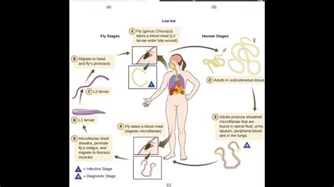 Loiasis- cause, pathology and diagnosis - YouTube