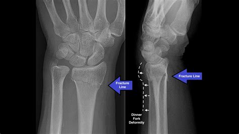 Lateral Wrist X Ray Labeled