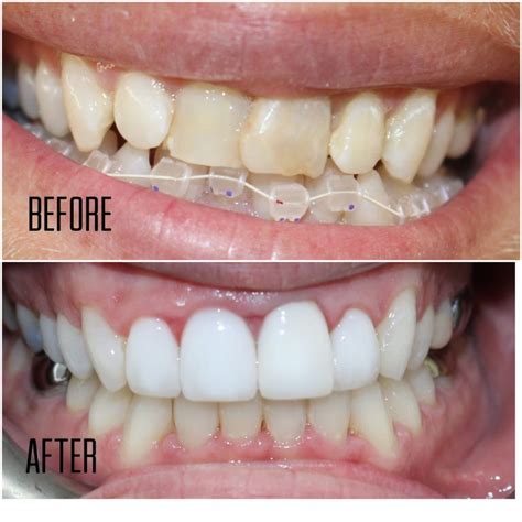 5 Before and After Invisalign Transformations | Tooth Doctor