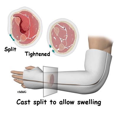 Adult Wrist Fractures - Midwest Bone and Joint Institute - Illinois