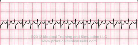 Taquicardia Supraventricular Guida de referencia