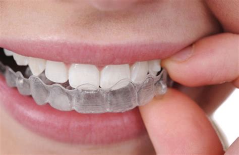 Invisalign in Madison, AL | Madison Dental Care