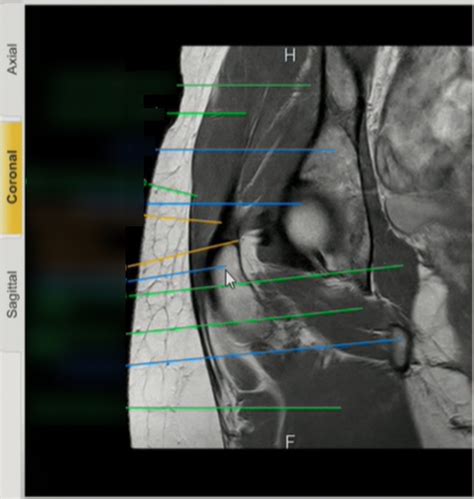 Coronal Hip MRI 12 Diagram | Quizlet