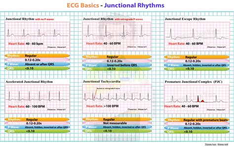 Different Types Of Heart Blocks