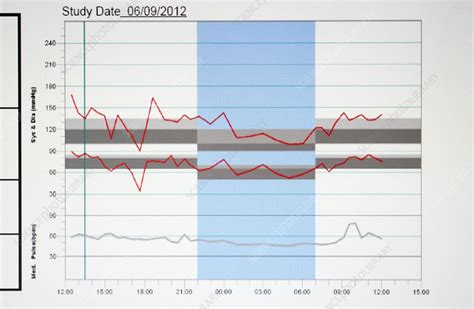 Ambulatory blood pressure monitoring - Stock Image - C015/4027 ...