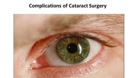 Cataract eye surgery complications