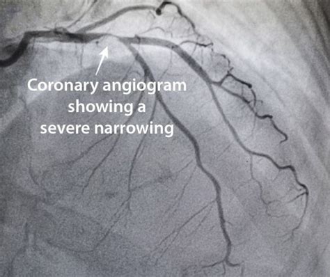 Coronary Angiography - Capital Heart Centre