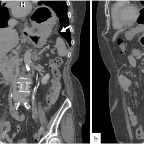 HALS for repair of the Bochdalek hernia. a. Adhesions around the ...