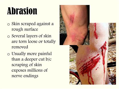 Abrasion Wound Diagram