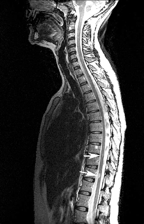 Spinal cord MRI in clinically isolated optic neuritis | Journal of ...