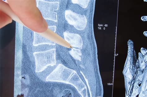 An Introductory Guide to Spinal Stenosis Surgery - Howell Allen Clinic