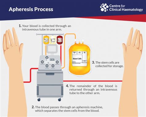 Peripheral blood stem cell collection | CFCH | Centre for Clinical ...