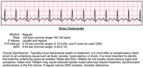 Paroxysmal Atrial Tachycardia Vs Sinus Tachycardia