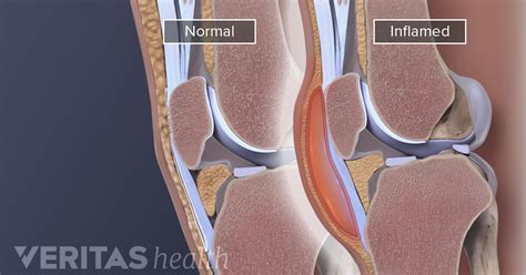 Knee (Prepatellar) Bursitis