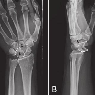 (a) Clinical appearance of the patient's wrist. (b) Lateral wrist ...