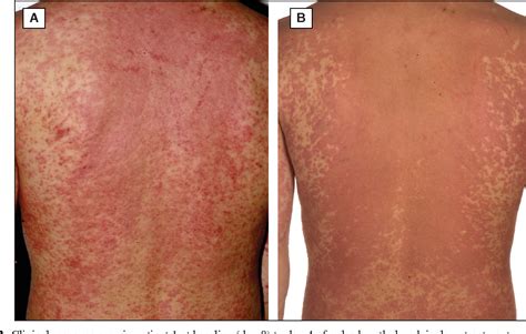 Figure 2 from Ten cases of drug reaction with eosinophilia and systemic ...