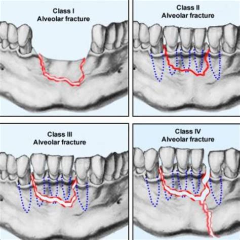 Alveolar Fracture | News | Dentagama