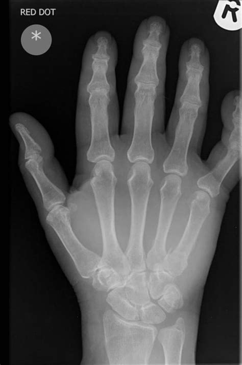 Broken Finger X Ray