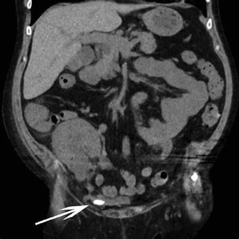 Computerized tomography imaging of a 62-y-old patient confirming ...