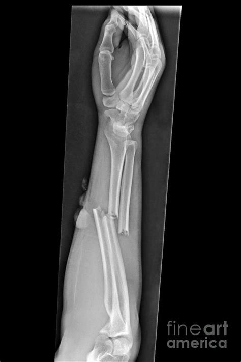 Broken Arm, X-ray by Science Photo Library