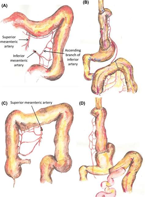 Diagrams representing right and left colonic interposition operations ...