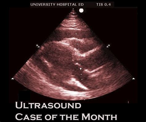 Ultrasound Case of the Month: Delayed Postpartum Hemorrhage — Taming ...