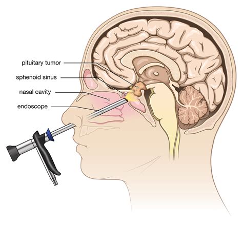 Pituitary Tumor Symptoms and Treatment - Goodman Campbell