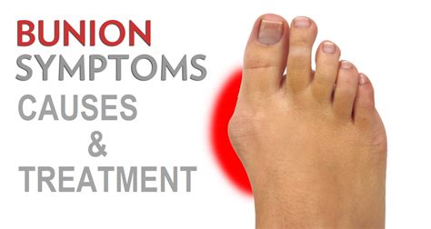 Bunions : Causes, Symptoms, And Treatment