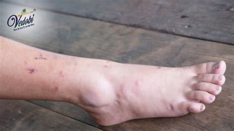 Vedobi - Gangrene Symptoms, Causes, Diagnosis and Treatment