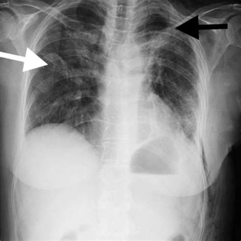 a. CT of the chest revealed a 2,5-cm cavitary nodular lesion in the ...