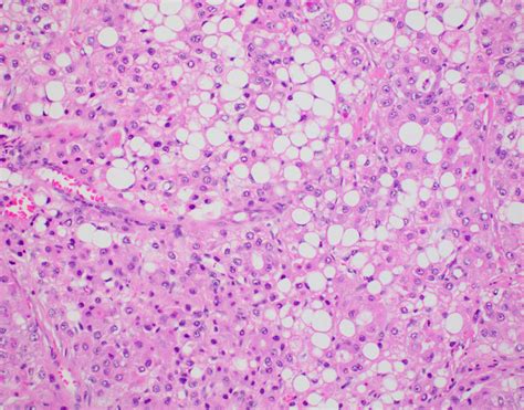 Hepatocellular Carcinoma Histology