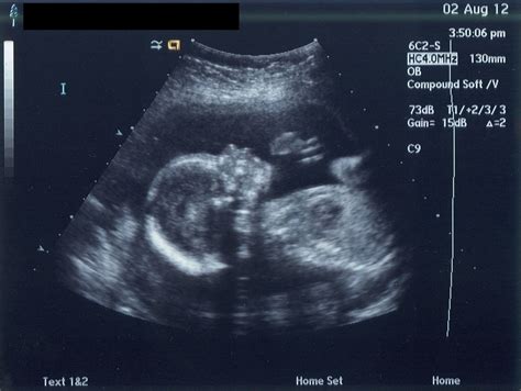 30 weeks pregnant 3d ultrasound - worldinriko