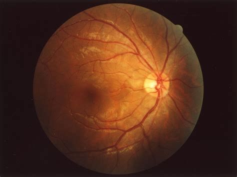 Fundus (eye) - Wikipedia