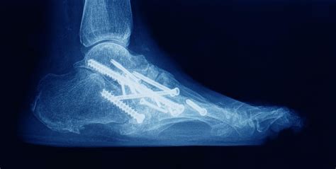 Ankle Arthrodesis