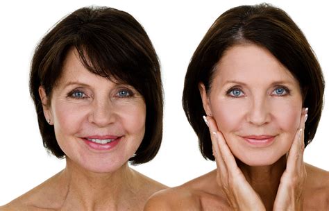 Cost of Facelift Surgery - Benefits, Recovery, Results to Expect, etc