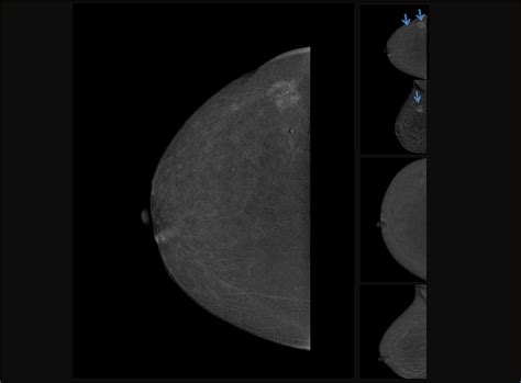 Titanium Contrast Enhanced Mammography (TiCEM) with 50° Wide-Angle HD ...