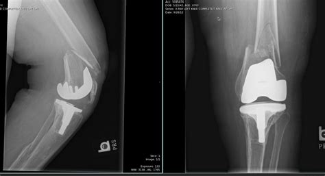 Periprosthetic Fracture Classification