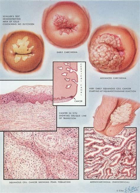 Colposcopy Procedure for Pregnant Women | Greenslopes Obstetrics ...