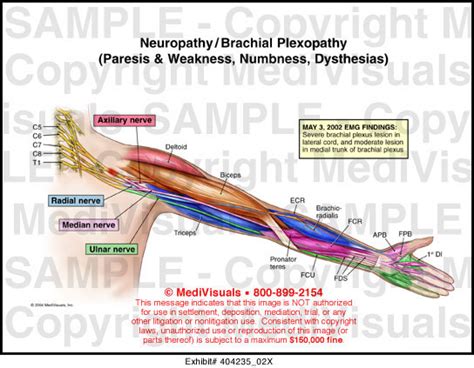 Medivisuals Neuropathy/Brachial Plexopathy (Paresis & Weakness ...