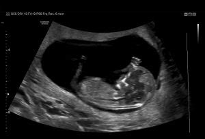 12-14 Week Scan - Women's Imaging