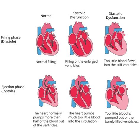 Why is Every 3rd Person in the Population Suffering from a heart attack ...