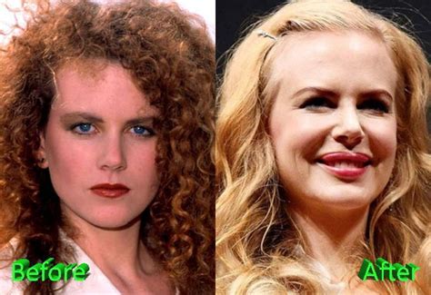 Nicole Kidman plastic surgery | Ünlüler